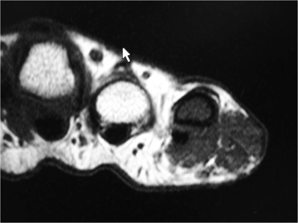 Giant Cell Tumor Of Tendon Sheath